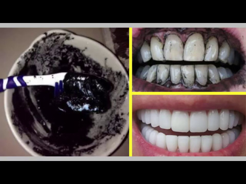 طريقة استخدام تبييض الأسنان بالفحم