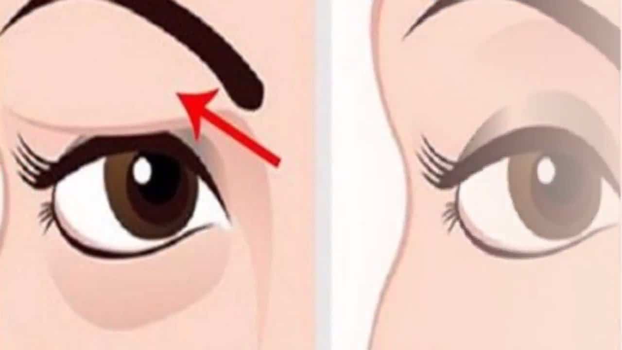 مكياج الجفون المترهلة وأهم تمارين شد العين عميد الطب