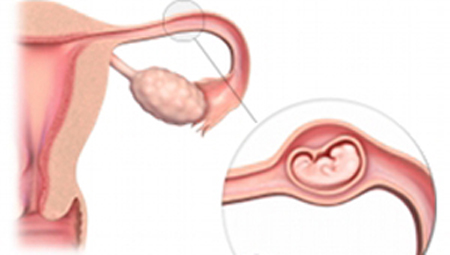 علامات الحمل خارج الرحم