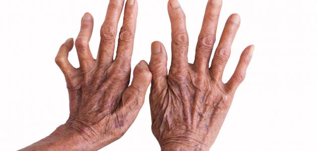 مرض الجذام أسبابه وأعراضه