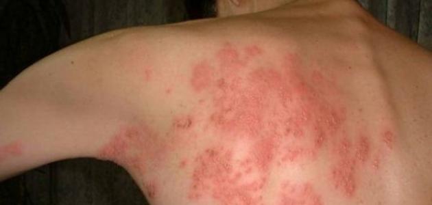 مرض الحزام الناري أعراضه وأسبابه