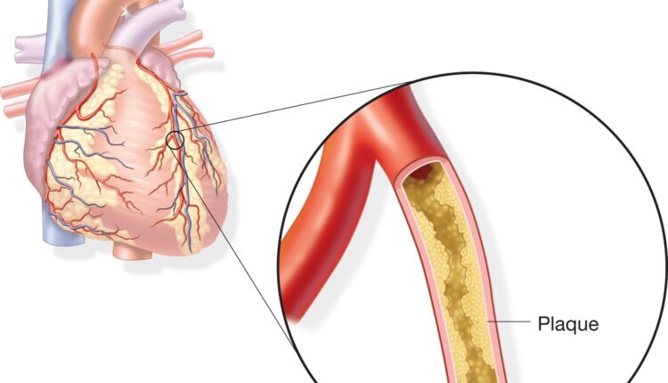 أعراض مرض الشريان التاجي وعلاجه