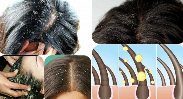 وصفة مجربة لإزالة القشرة من الشعر