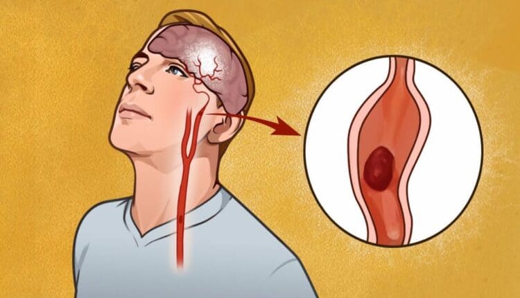 أعراض السكتة الدماغية الإقفارية وعلاجها