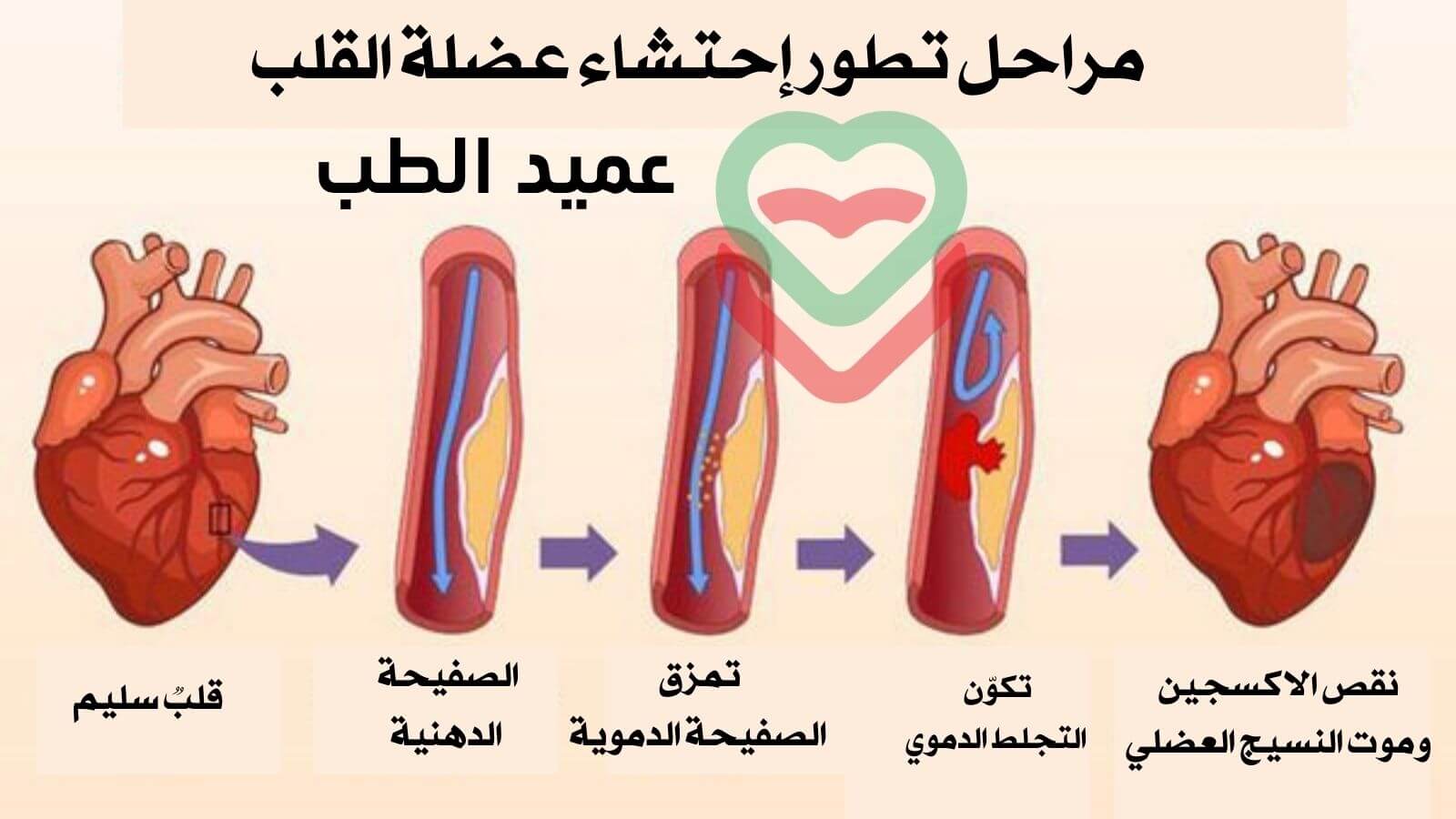 احتشاء عضلة القلب